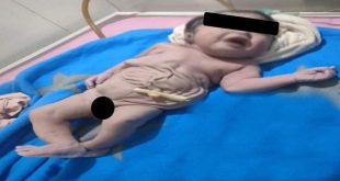 ولادة طفل دون بطن