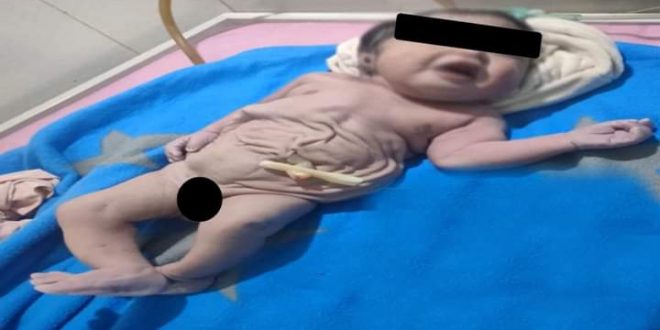 ولادة طفل دون بطن