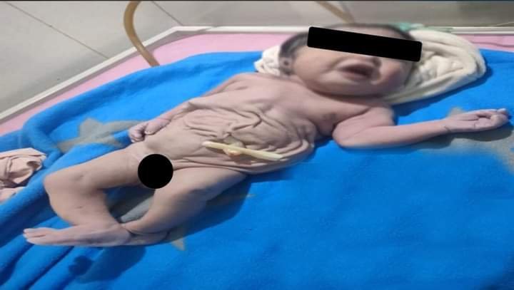ولادة طفل دون بطن