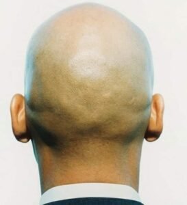 الرجل الأصلع